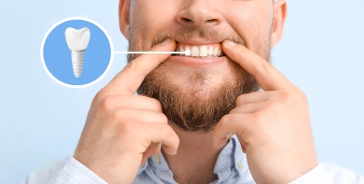 Does dental insurance cover implants? photo